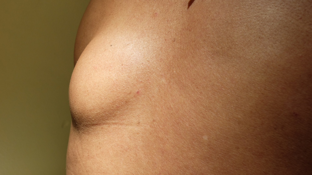 Lipoma,At,The,Upper,Back.,Benign,Subcutaneous,Swelling,Containing,Fat