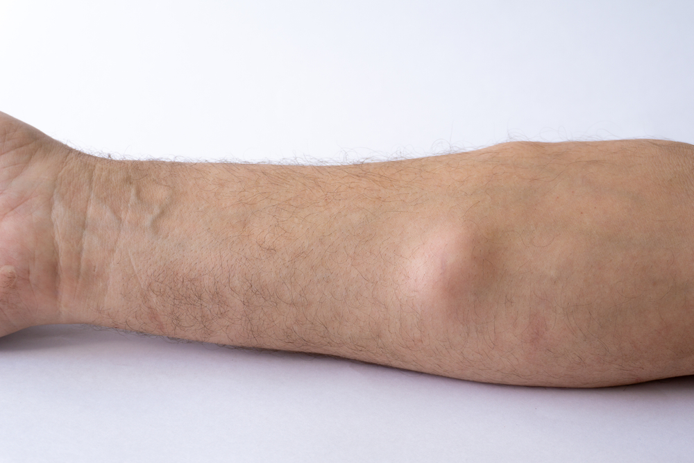 Lipoma,,A,Benign,Neoplasm,,A,Tumor,On,The,Forearm,Of