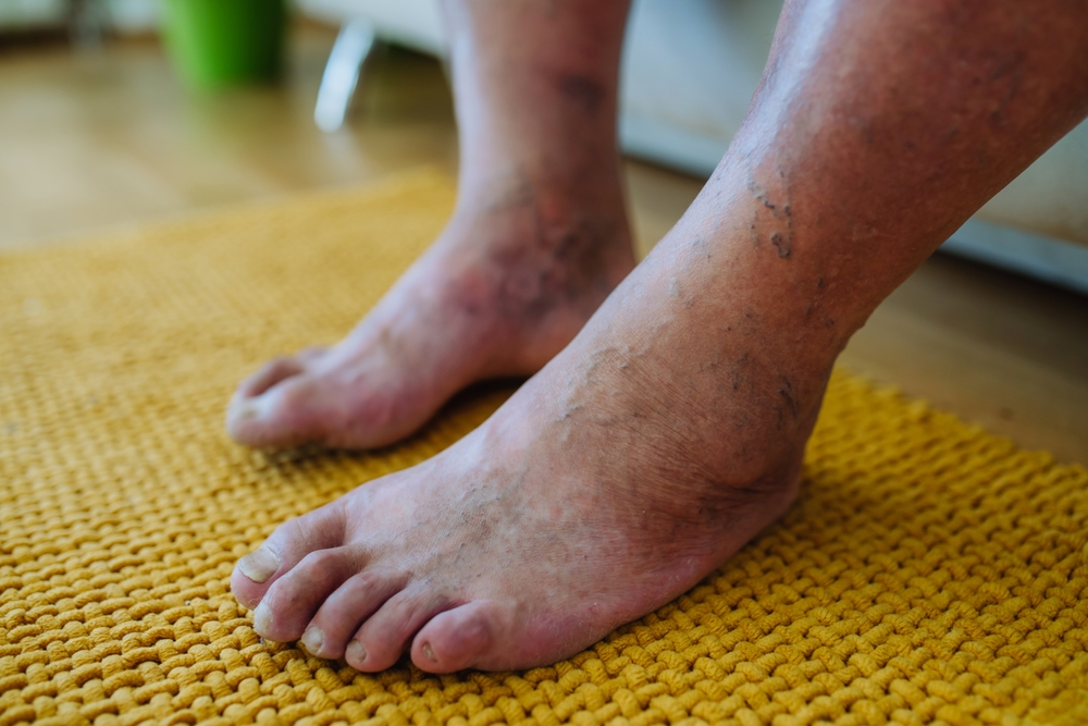 A,Close-up,Shot,Of,Man’s,Feet,With,Diabetic,Foot,Complications.